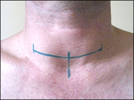 Разметка перед операцией (вертикальные полоски обозначают края шва и его середину, разрез проводится только по горизонтальной линии).