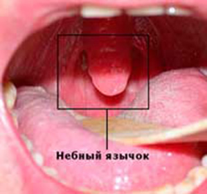 Отек язычка может быть вызван инфекционными заболеваниями, травмой или аллергией.
