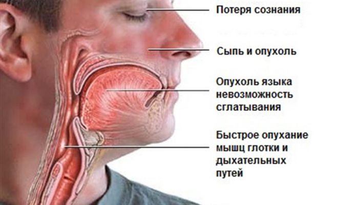 При анафилактическом шоке организм резко и остро реагирует на аллерген.