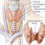 Как проводят субтотальную резекцию щитовидной железы?